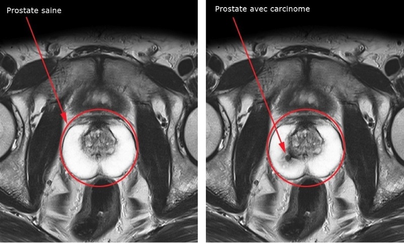 Prostate saine carcinome 002