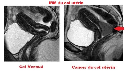 irm.cancer.du.col.001