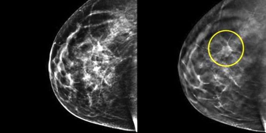 mamographie cancer du Sein 001