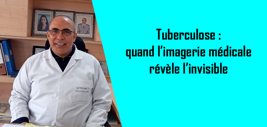 Tuberculose : quand l’imagerie médicale révèle l’invisible